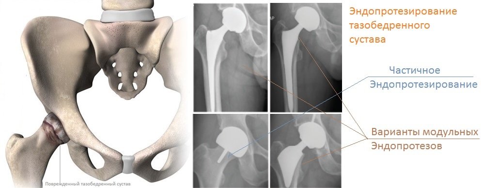 Hip replacement in clinics of Pucxon